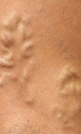 Mask-Group-45 What happens if varicose veins are left untreated