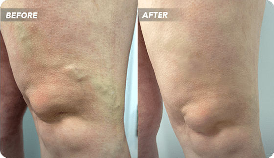 What are the treatment options for varicose veins?