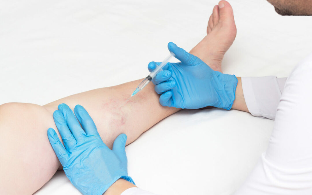 What Causes Spider Veins On Legs?